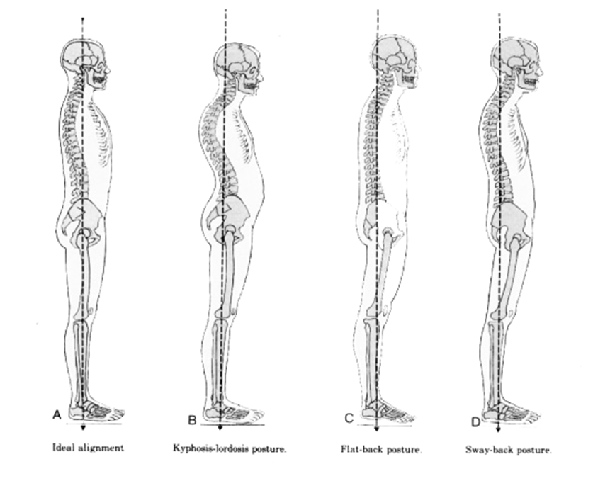 different postures of human based on pelvic, spine, neck. flat black posture, sway back posture, lordosis posture and ideal alignment